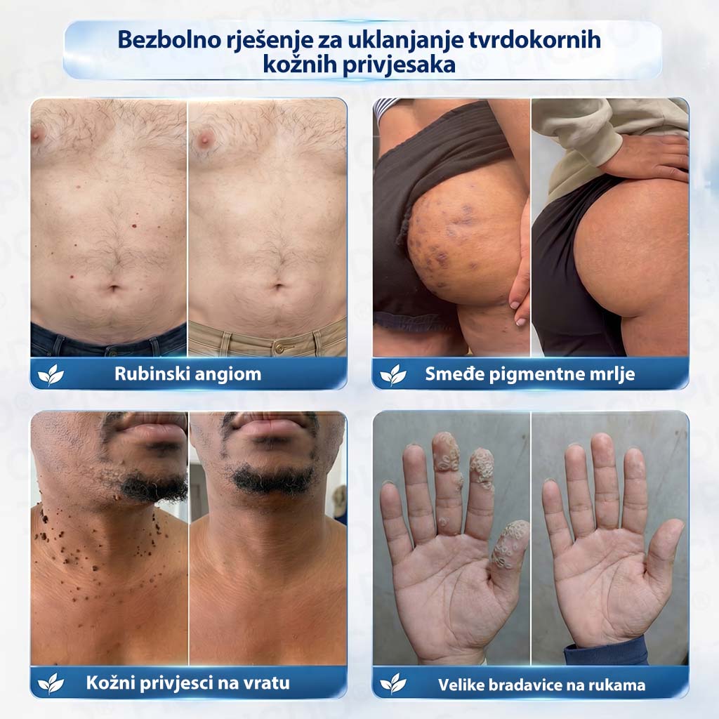 𝐏𝐢𝐜𝐝𝐨®🧑‍⚕️ 7-dnevna 𝐤𝐫𝐞𝐦𝐚 𝐳𝐚 𝐤𝐨ž𝐧𝐞 𝐢𝐳𝐫𝐚𝐬𝐭𝐚𝐣𝐞 & 𝐩𝐢𝐠𝐦𝐞𝐧𝐭𝐚𝐜𝐢𝐣𝐬𝐤𝐞 𝐦𝐫𝐥𝐣𝐞 (bezbolna formula – bez ožiljaka)