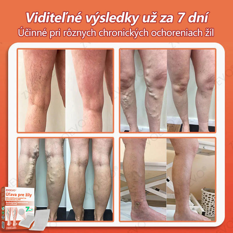 ☘️ Zvoevo® Vein Ease mikroihličková terapia (na metličkové žilky, kŕčové žily, opuchy nôh a únavu nôh)🎁