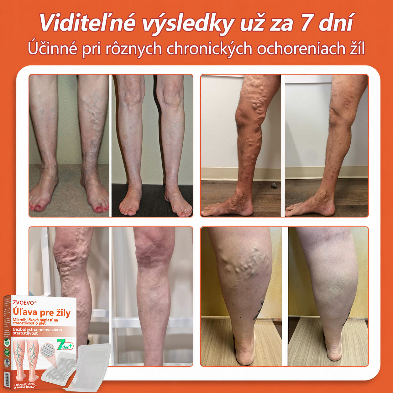 ☘️ Zvoevo® Vein Ease mikroihličková terapia (na metličkové žilky, kŕčové žily, opuchy nôh a únavu nôh)✅