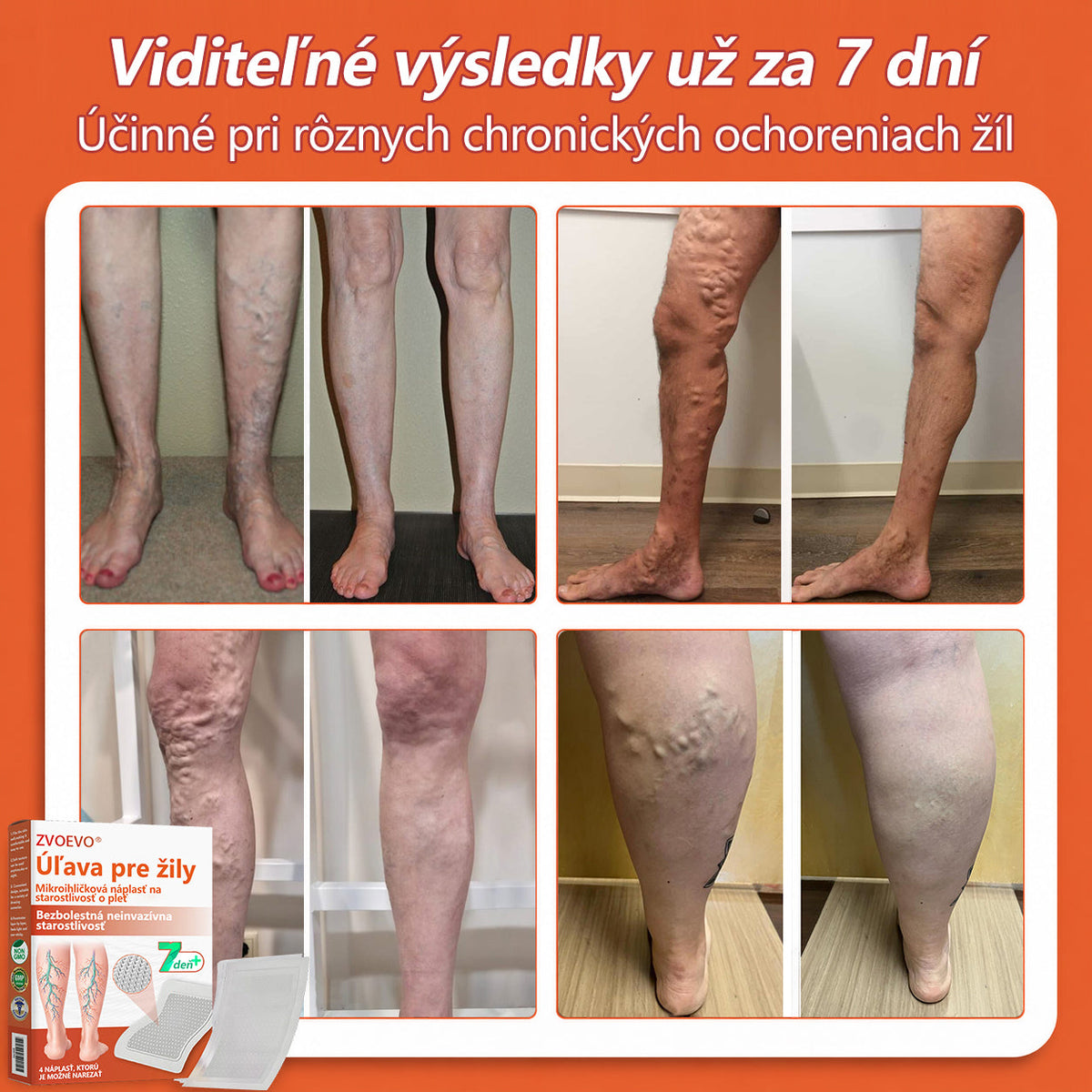 ☘️ Zvoevo® Vein Ease mikroihličková terapia (na metličkové žilky, kŕčové žily, opuchy nôh a únavu nôh)🎁