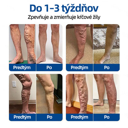 Healrize® VeinTarget mikrojihlová náplasť | Okamžitá úľava, dlhodobé výsledky