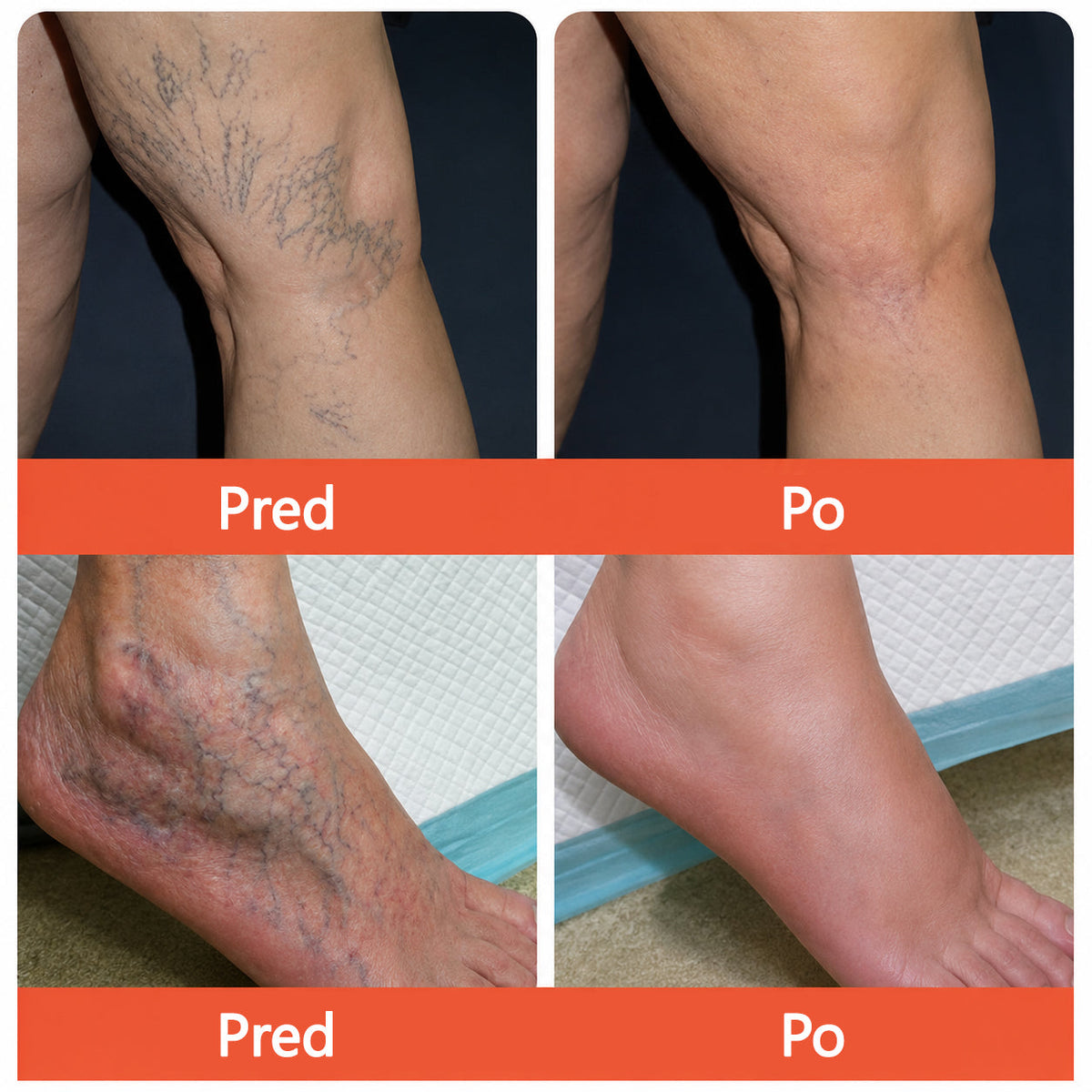 ☘️ Zvoevo® Vein Ease mikroihličková terapia (na metličkové žilky, kŕčové žily, opuchy nôh a únavu nôh)🎁
