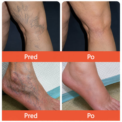 ☘️ Zvoevo® Vein Ease mikroihličková terapia (na metličkové žilky, kŕčové žily, opuchy nôh a únavu nôh)✅