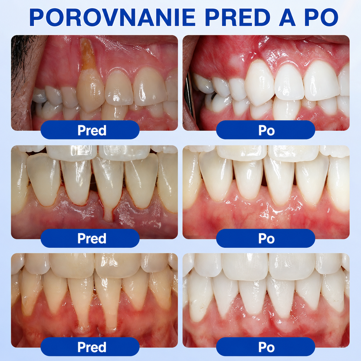👨‍⚕️🦷 Evolvion® GumRevive – regeneračný gél na parodont🎁