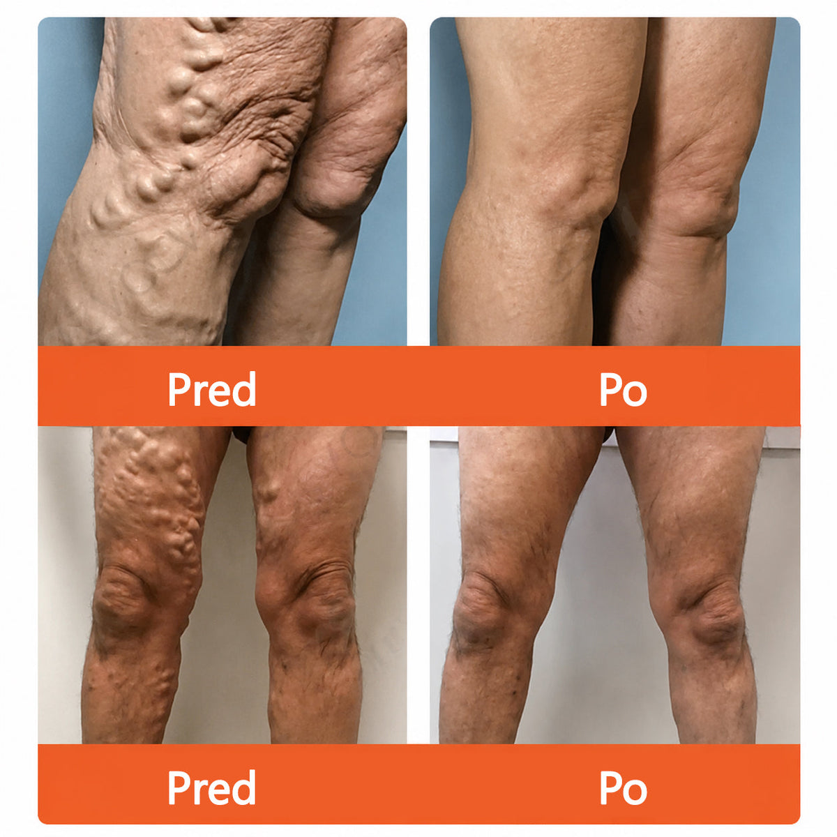 ☘️ Zvoevo® Vein Ease mikroihličková terapia (na metličkové žilky, kŕčové žily, opuchy nôh a únavu nôh)🎁