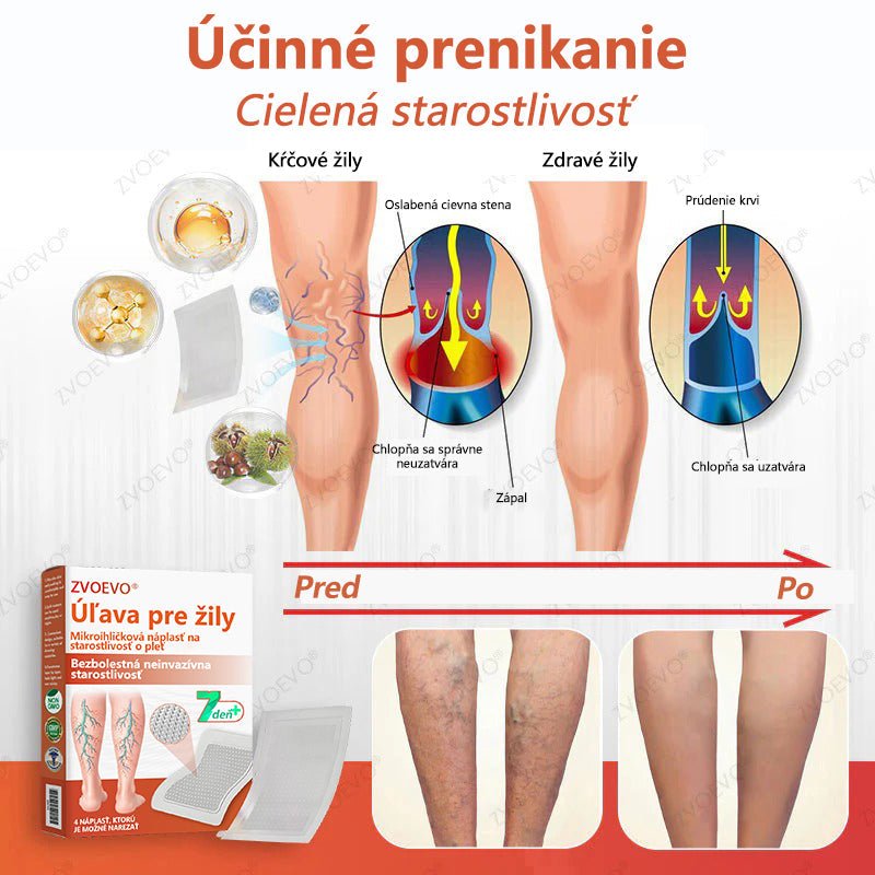 ☘️ Zvoevo® Vein Ease mikroihličková terapia (na metličkové žilky, kŕčové žily, opuchy nôh a únavu nôh)🎁